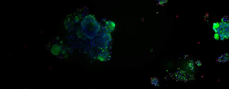 Colorectal cancer organoids