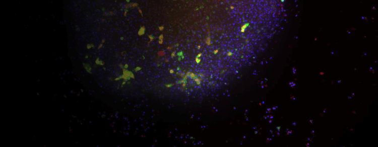 Colorectal Cancer Organoids